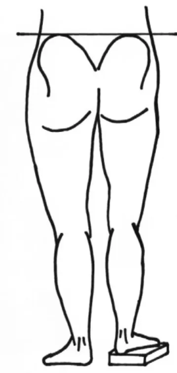 Fig. 1. Block test. Pelvis is leveled by placing a series of blocks under the shorter limb.