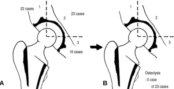 Fig. 4. Osteolysis around revised acetabular cup. There was no osteolysis around acetabular cup in revision group.