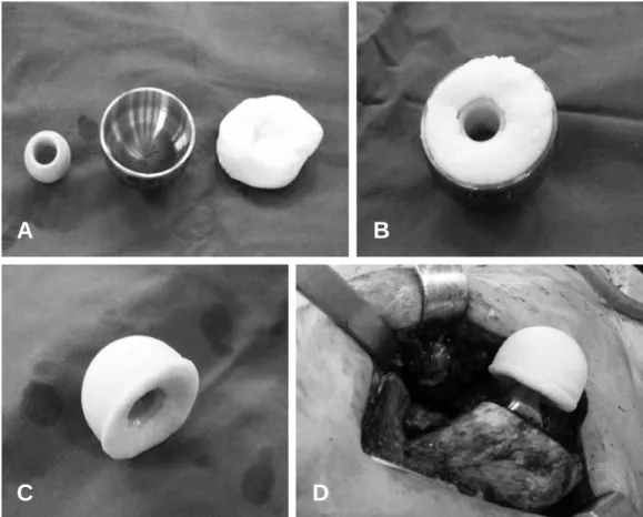Fig. 1. Molding process of antibiotics loaded cement spacer. (A) The spacer consists of a bipolar head, shell and antibiotics-mixed cement