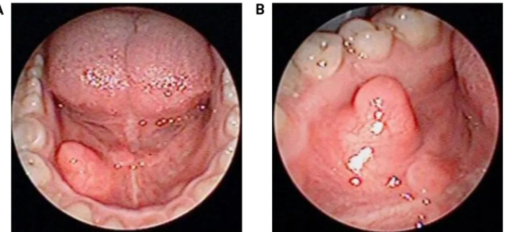 Fig. 1. The photos of mass (A, B). The mass is a well-defined swelling on the right side of the floor of the mouth, which is covered with the normal mucous membrane.