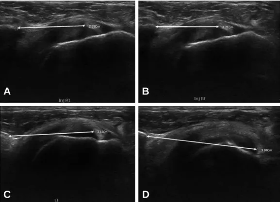 Fig. 1. Line 1 (CBT, Coracoid process~Biceps long head) with neutral posion in frozen shoulder side was 2.33 mm (A) and in external rotation was 2.21 mm (B), which revealed narrowing of the joint space related to soft  tis-sue contracture