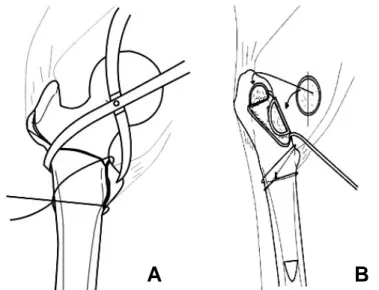 Fig. 1. (A) The lesser trochanter is reattached with a double loop wiring. (B) A autograft is cut from the head/neck fragment to fit on posteromedial aspect and greater trochanter.