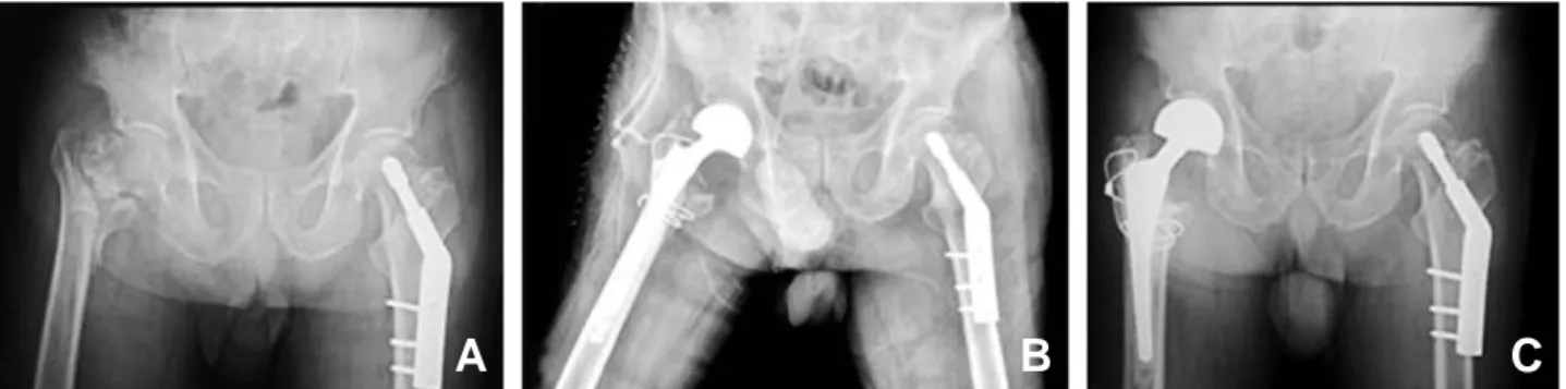 Fig. 2. (A) Preoperative radiograph of a 84 year-old woman shows comminuted unstable femoral intertrochanteric fracture