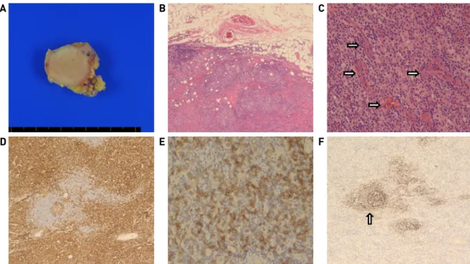 Fig. 3. Pathological findings. The surgical specimen shows a 1.9 X 1.4cm sized relatively well-circumscribed nodular lesion (A)