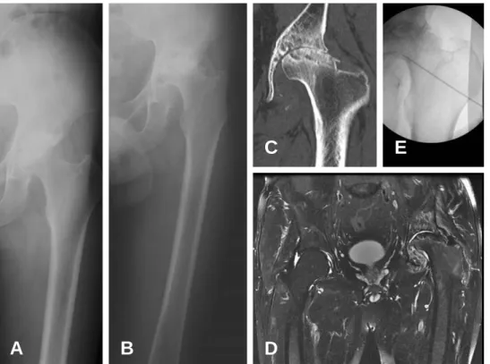Fig. 3. Case 2. (A) Anteroposterior view of the left hip joint, obtained at the onset of left hip joint pain