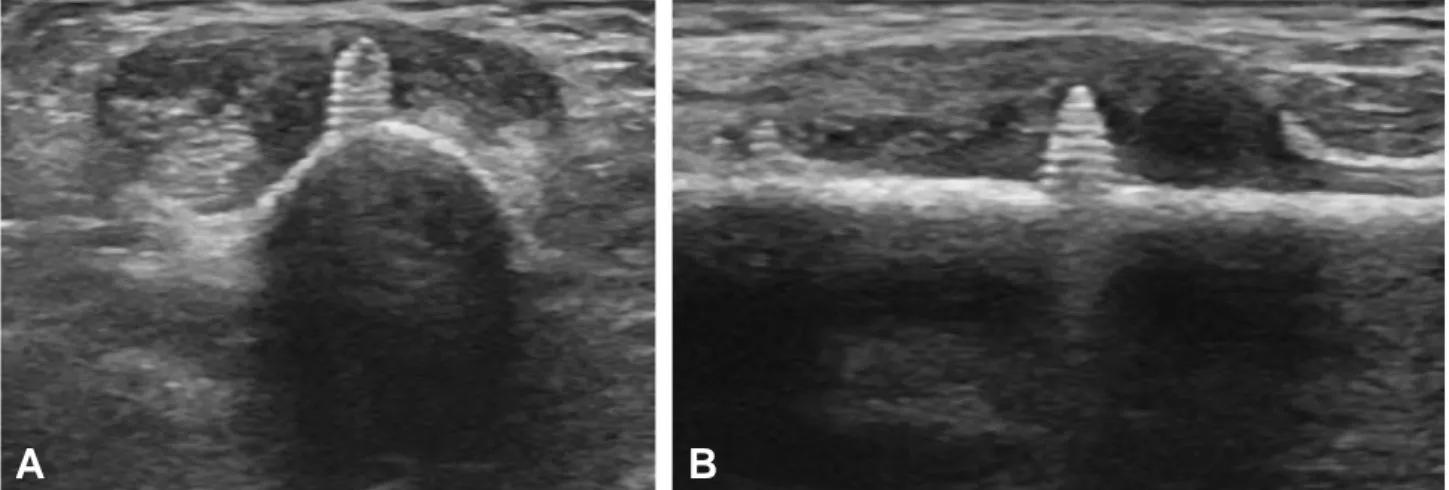 Fig. 4. Intraoperative findings of (A) tenosynovial mass and (B) prominent screw tip just beneath the mass and extensor tendons.
