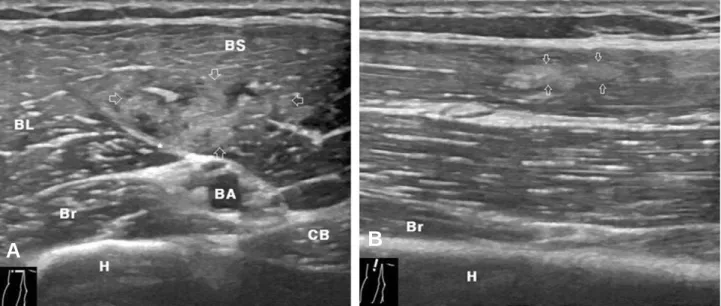 Fig. 2. Sonographic image after 5 months. (A) Transverse scan shows poorly demarcated area of increased echogenicity by fibrous healing(open arrows)