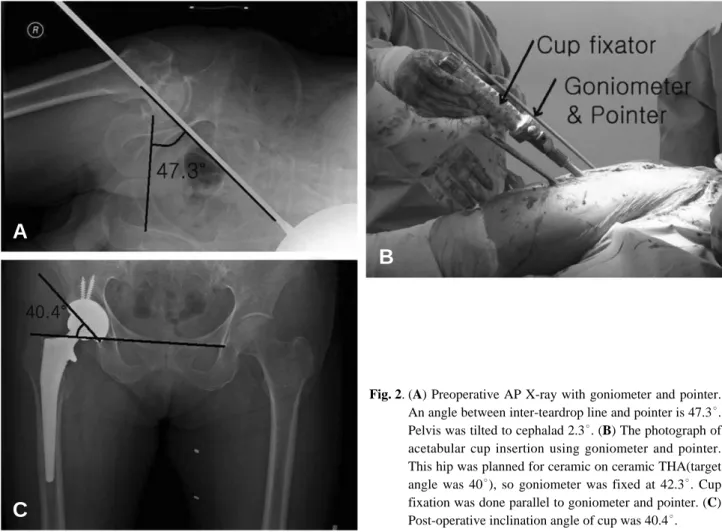 Fig. 2. (A) Preoperative AP X-ray with goniometer and pointer.