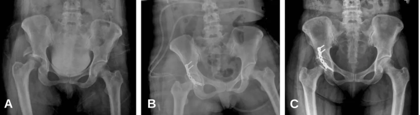 Fig. 2. (A) A 64-year-old man sustained Pipkin type IV fractures of hip. (B) Open reduction and internal fixation with one 3.5mm screw and spring plate and reconstruction plate