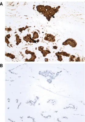 Fig. 4. Immunohistochemical staining for CK7 is positive (x200) (A), negatively staining for CK20 (x200) (B).