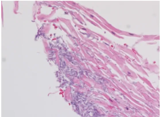 Fig. 3. Histopathological examination of laryngeal mucosal  surface; Fungal septate hyphae visible in a hyperplastic  en-dolaryngeal epithelium (H&amp;E stain, X400)