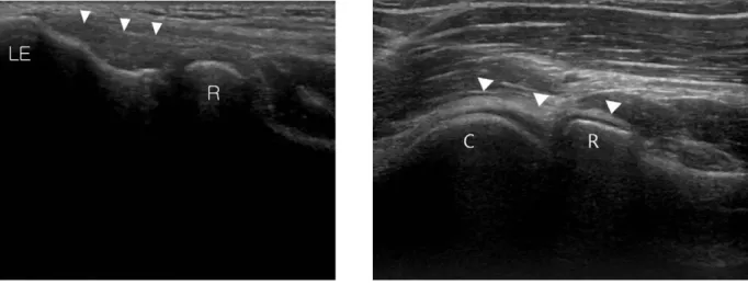 Fig. 4. Fibrillar appearance of common extensor ten- ten-don (arrow head) is demonstrating in  longitudi-nal image at the level of lateral epicondyle.
