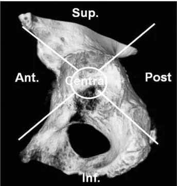 Fig. 1. The images of osteolytic lesion in computed tomography were reconstructed in 3D images using Rapidia 2.8.