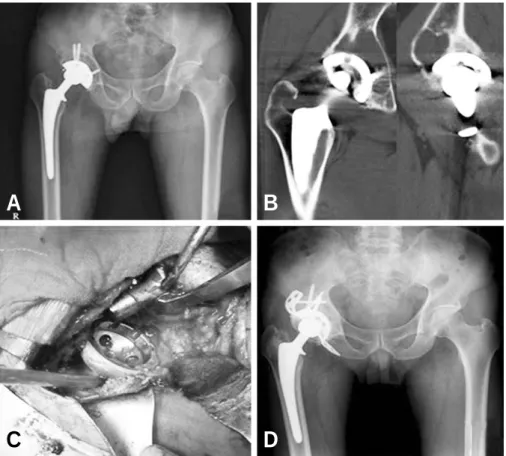 Fig. 6. The volume of osteolytic lesion was statistically related to the amount of the polyehylene wear (Rs=0.581).