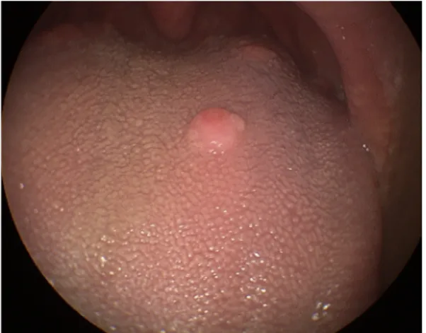 Fig. 1. Preoperative endoscopic finding shows a round, sessile mass in dorsal surface of the tongue