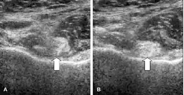 Fig. 1. 55-year-old female with greater than 10-year history of hip pain with catching and a snap, especially with rotation, with a dynamically confirmed snapping hip
