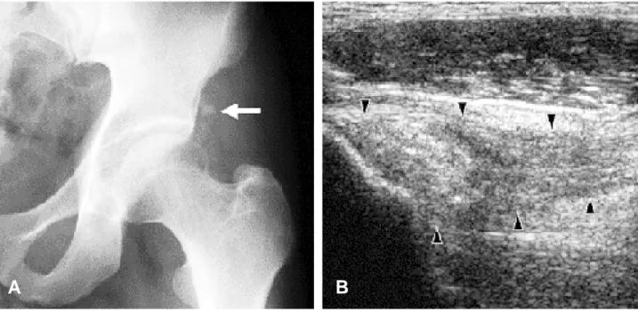 Fig. 7. 34-year-old man with calcific tendinitis of the left rectus femoralis. (A) Radiography of the pelvis shows small calcifications adjacent to the acetabulum, suggesting calcifications in the orgin rectus femoris tendon