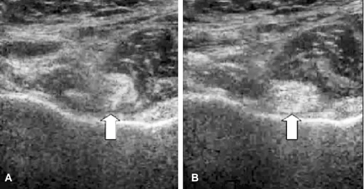 Fig. 8. Magnetic resonance image demonstrates the slightly hypertrophied right piriformis muscle (arrow) of the right hip