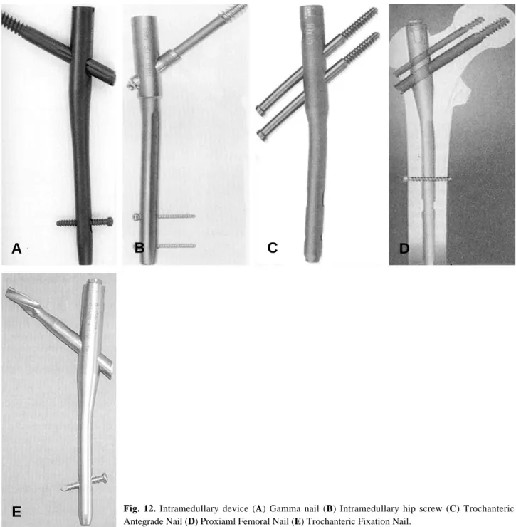 Fig. 12. Intramedullary device (A) Gamma nail (B) Intramedullary hip screw (C) Trochanteric Antegrade Nail (D) Proxiaml Femoral Nail (E) Trochanteric Fixation Nail.