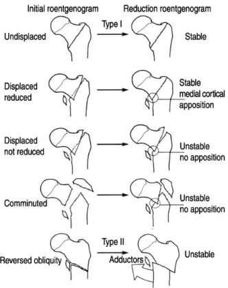 Fig. 8. Evans classification of intertrochanteric fractures based on direction of fracture.