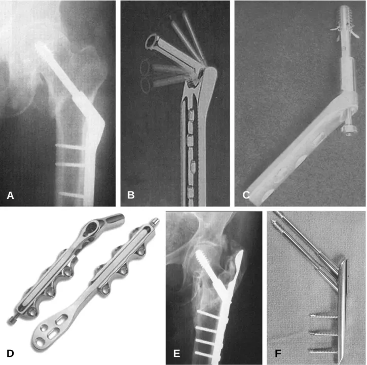 Fig. 11. Sliding compression hip screw. (A) Conventional sliding hip screw (B) Variable angle hip screw (C) Talon compression hip screw (D) Medoff plate (E) Trochanteric stabilizing plate and Lateral buttress plate (F) Percutaneous Compression plate.