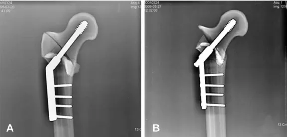 Fig. 4. Biomechanical study of group 1(CHS group). (A) Anteroposterior radiographs of the bone-plate complex before Instron loading
