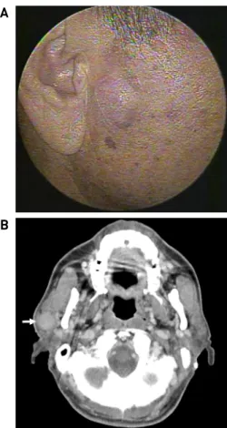 Fig. 1. Facial photography (A) and computed tomography  (CT) scan (B) of the patient at initial visit