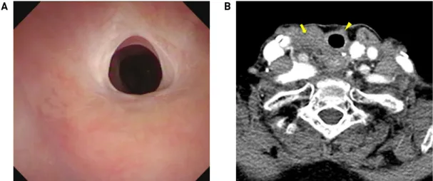 Fig. 3. (A) The cervical tracheal lumen was observed to be patent in a flexible laryngoscope a year after the surgery