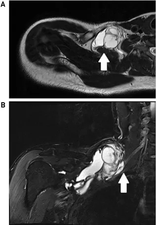 Fig. 3. The operative finding revealed cystic mass abutting  scalene muscle (white arrow) and brachial plexus (blue  ar-row) (Fig