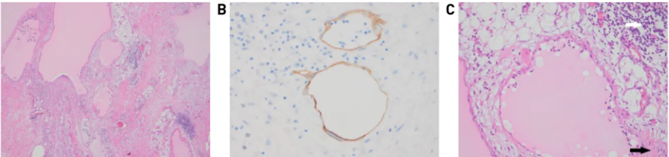 Fig. 5. Microscopically, large, irregular vascular spaces (Fig. 5A, H&amp;E x40) lined by flattened endothelial cells, which were positively stained with D2-40 immunohistochemical stains (Fig