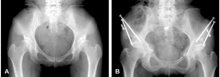 Fig. 2. This patient is 45-year-old female. (A) Preoperative radiograph shows dysplasia at both hips
