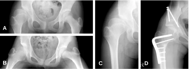 Fig. 3. This patient is 13-year-old female. (A) Both hips AP radiograph shows dysplasia of right hip and deformed right femoral head