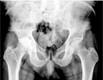 Fig. 1. Plain radiograph of a 65-year-old man shows the advanced osteoarthritis in right hip