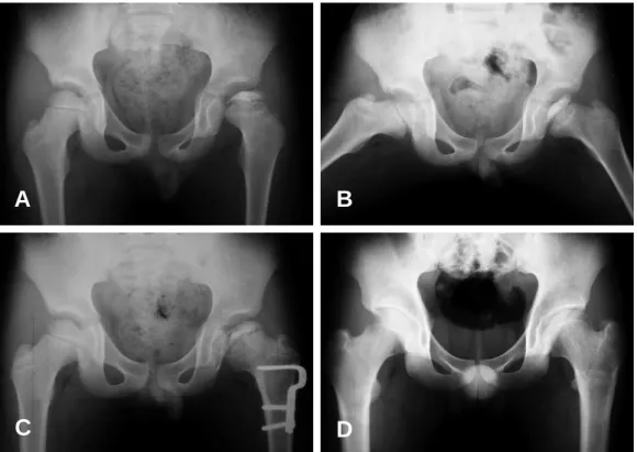 Fig. 2. (A) Anteroposterior radiograph in a 8-year-old boy shows LCPD finding of left hip with fragmentation stage and lateral pillar B involvement