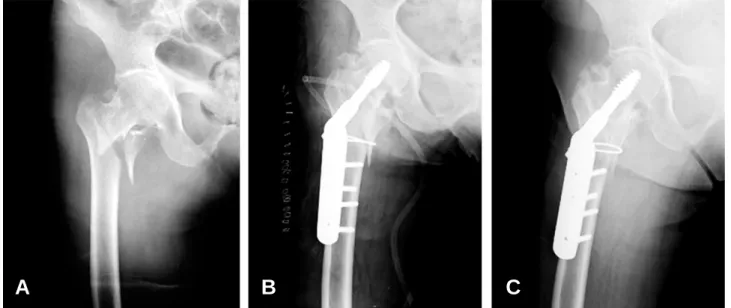 Fig. 2. (A) 79 year-old man. The X-ray showing type llB intertrochanteric Fx. (B) Immediate postoperative X-ray showing anatomical reduction and fixation of lesser trochanter with cable