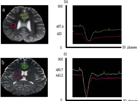 Fig.  2.  Comparison  of  white  and  gray  matter  with  time-signal  intensity(SI)  curve  of  Spin  echo  EPI  in  75  adults  and  25  pediatric  patients(a  :  adults,  b  :  pediatric  patients)