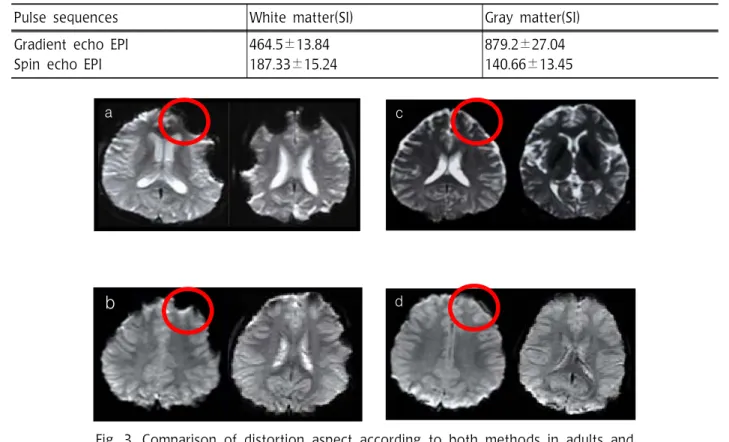 Table  2.  Average  SIs  of  white  and  gray  matter  with  both  methods  in  75  adults  and  25  pediatric  patients