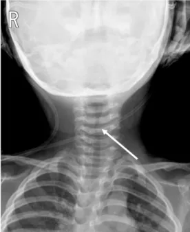 Fig. 1. Neck AP shows about 6mm sized asymmetric protrud- protrud-ing mass on left wall of subglottic area.