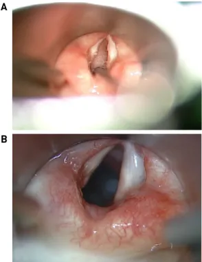 Fig. 3. Subglottic cyst marsupialization and cyst excision were done. (A) Pretreatment subglottis status with left subglottic  cyst near-totally obstructing the airway