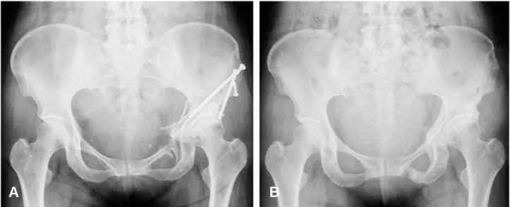 Fig. 2. (A) Postoperative radiograph shows satisfactory correction and fixation using cortical screws