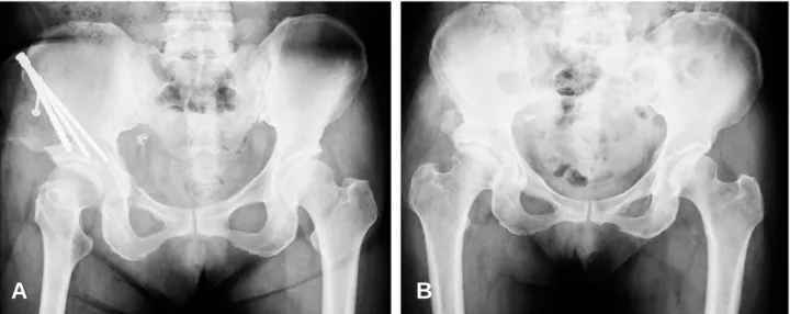 Fig. 4. (A) Postoperative radiograph shows satisfactory correction and fixation. (B) Radiograph obtained 1 year after surgery shows complete union and enough coverage without any progression of osteoarthritis in right hip.