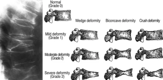 Fig. 3. Grading system as used for semiquantitative assessment of vertebral deformity in Genant score 18) .