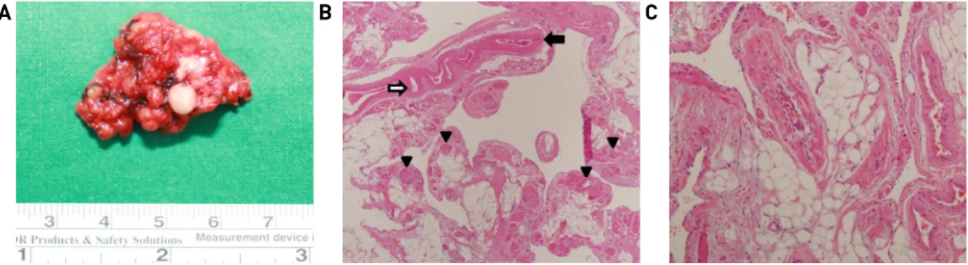 Fig. 3. Pathological findings. The surgical specimen shows a 3.0 X 2.5cm sized mass with multiple calcified nodules (black arrows)  (A)