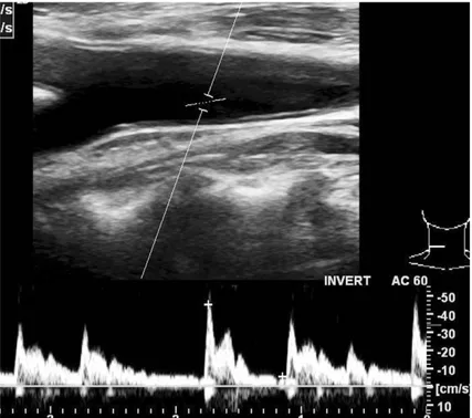 Fig. 3. Sonogram of right carotid artery shows intima thickening and narrowing about 70%.