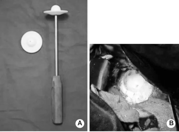 Fig. 1. Photography shows specific device for indentation molding which imprint on acetabular antibiotic impregnated cementing (A) and acetabular antibiotic impregnated cementing was completed (B)