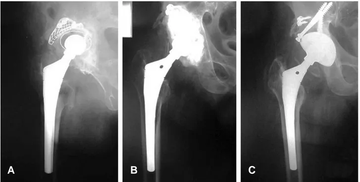 Fig. 2. (A) Preoperative anteroposterior radiograph of a 60 year-old male demonstrates a loosening of total hip arthroplasty