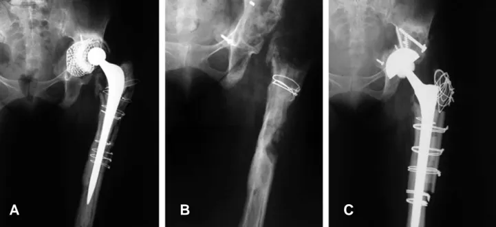 Fig. 4 (A) Preoperative anteroposterior radiograph of a 44 year-old female demonstrates a loosening of total hip arthroplasty.