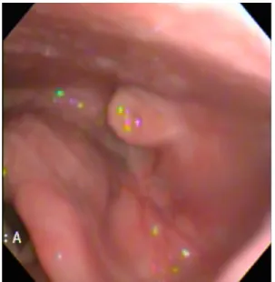 Fig. 2. Preoperative Neck computed tomographic scan Image Preoperative computed tomographic scan shows a 1.1 x 1.0  cm non-enhancing iso-dense mass in the left  hypophar-yngeal wall (arrow).