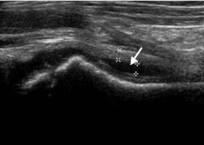 Fig. 3. 47 year old male complained painful swelling of right proximal thigh after strenuous activity.
