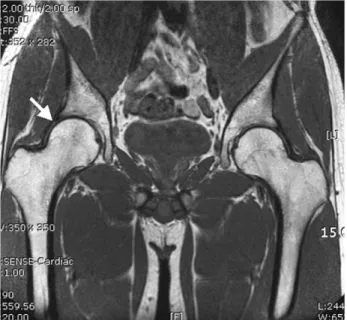 Fig. 4. Acetabular labrum or articular cartilage usually cannot be delineated in routine T1 weighted MR images (arrow).